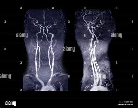 Mra Brain And Neck Or Magnetic Resonance Angiography Mra Of