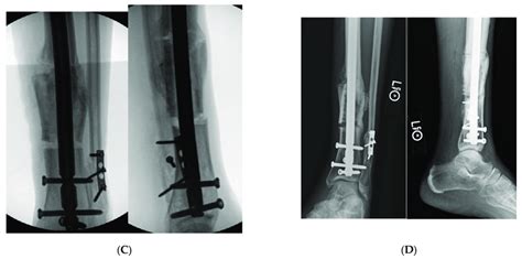 A Ap And Lateral Tibial Xr Demonstrating Failure Of Tibial Nail With
