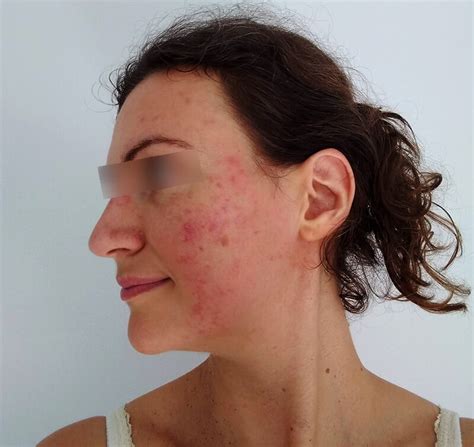 Qanda How Are Acne And The Papules And Pustules Of Rosacea Different