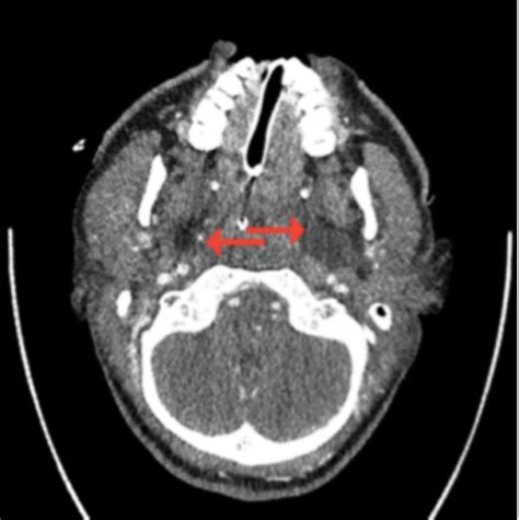 Ludwigs Angina A Case Report Oral Health Group