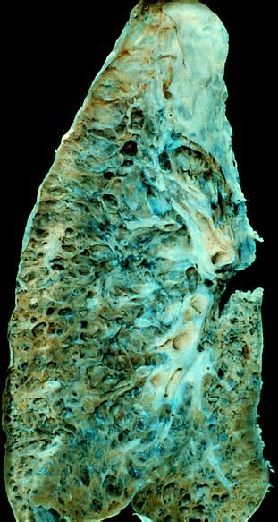 Interstitial Lung Disease Wikipedia