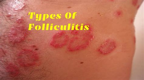 Types Of Folliculitis