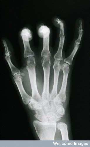 Psoriatic Arthritis Xray Showing Classical Distal Phalan Flickr
