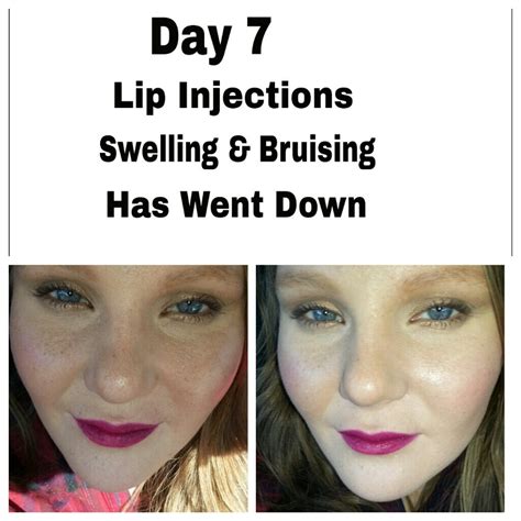 Erika Loves Beauty My Lip Injections Juviderm Fillers Experience