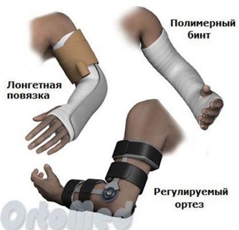 Fractured Elbow Cast Guide Physical Therapy Guide To Elbow Fracture