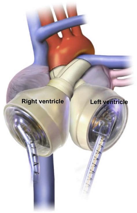 Artificial Heart Total Artificial Heart Complications And Life Expectancy
