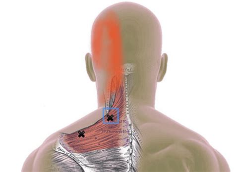 Trapezius Trigger Points