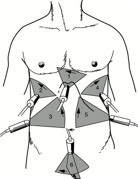 The Focused Trauma Ultrasound Examination Can And Should Accident