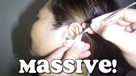 Womans Massive Solid Rock Hard Earwax Removal Youtube