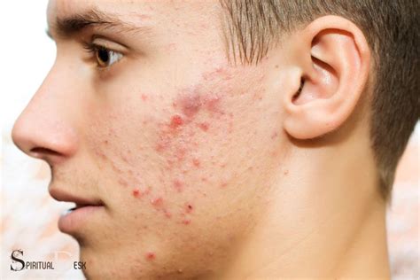 What Is The Spiritual Meaning Of Acne Genetics
