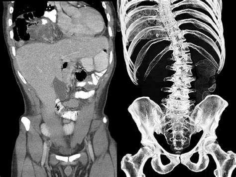 Coronal Ct Scan Of Abdomen And Pelvis With Intravenous And Oral