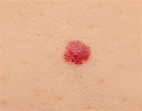 Cherry Angiomas And Red Spots Treatment Llc Cosmetic