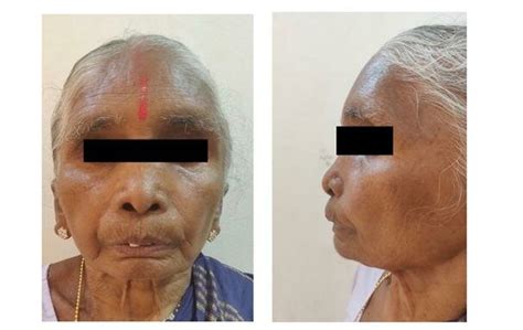 Extraoral Clinical Photographs Showing Diffuse Swelling Of The Face