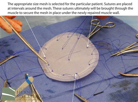 Hernia mesh pain symptoms range from temporary numbness, bruising and tenderness to severe researchers aren't sure how many people actually suffer from chronic hernia mesh pain because we still essentially do not know what goes into the makeup of these meshes. Hernia Types - Recurrent - California Hernia Specialists