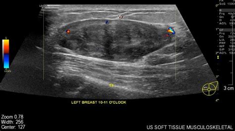 An Ultrasound Of The Breast Showing A Well Defined Hypoechoic Lesion