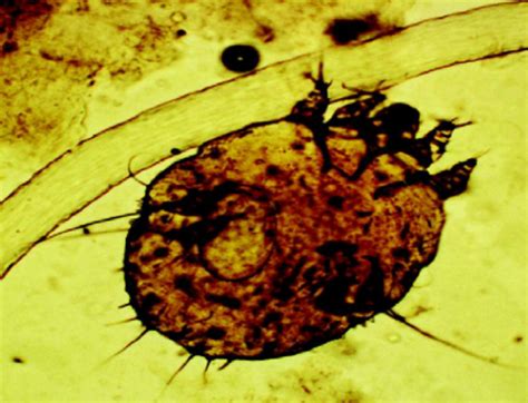 Female Scabies Mite With Egg Taken From 16 Skin Scraping