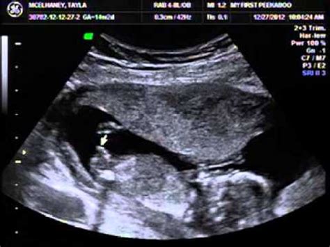How to know baby gender without ultrasound. Gender Reveal Ultrasound - YouTube