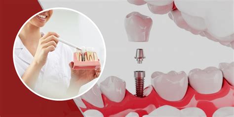 4 Types Of Dental Implants And Their Pros And Cons Onlymyhealth