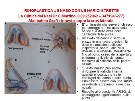 RINOPLASTICA : IL NASO CON LE NARICI STRETTE – Dott. Carmine Martino