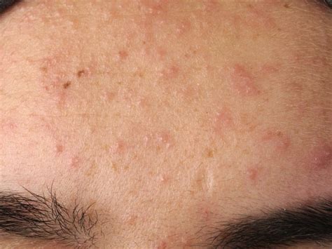 What Does Fungal Acne Look Like Pictures And Examples Seknd Blog
