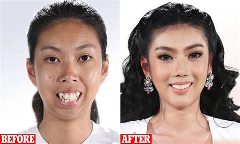 Plastic Surgery Results Shown In Before And After Photos Daily Mail Online