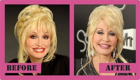Dolly Parton Plastic Surgery Before And After Dolly Parton ...