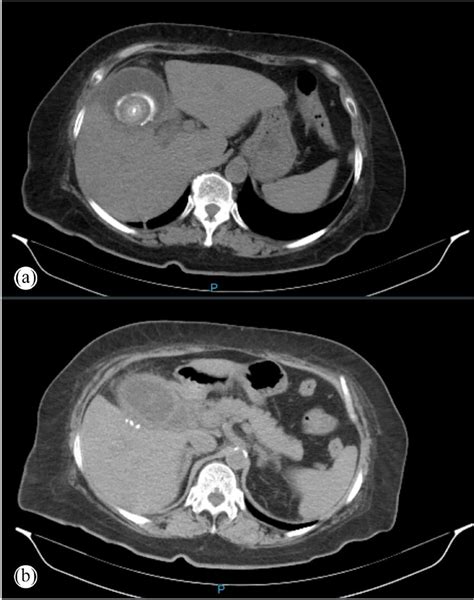 A Axial View Of The Abdominal Ct At Level Of T12 Vertebrae Showing