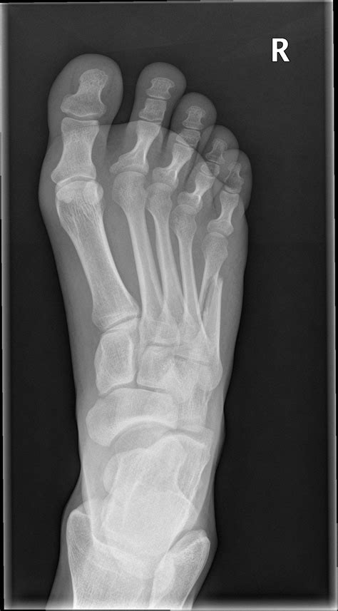 Spiral Fracture Fifth Metatarsal Shaft Image