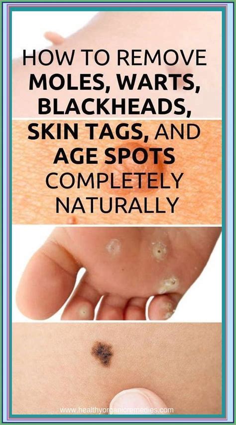 How To Get Rid Of Warts Moles Age Spots And Skin Tag Artofit