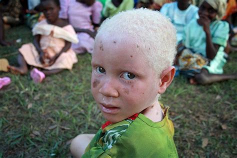 Albinos En África La Maldición De Los Niños Blancos