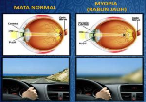 Selain menggunakan kacamata, penderita miopi bisa mengenakan lensa kontak. Kesan Penggunaan Gajet ke atas Mata Kanak-kanak - Diana ...