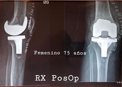 Prótesis De Rodilla Dr Jose Mario Dorantes Rodríguez Ortopedista Y
