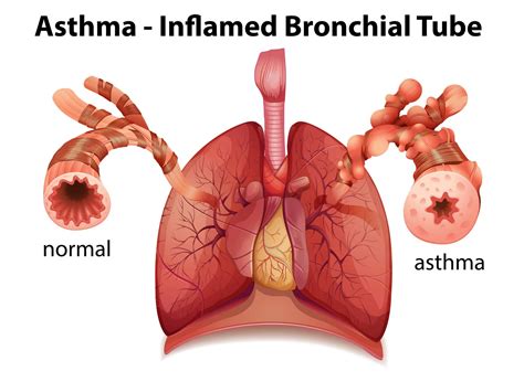 Understanding Severe Asthma Management Austrials Website