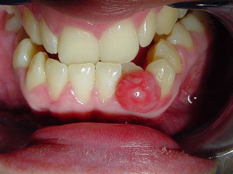 Oral Cancer Bumps On Tongue