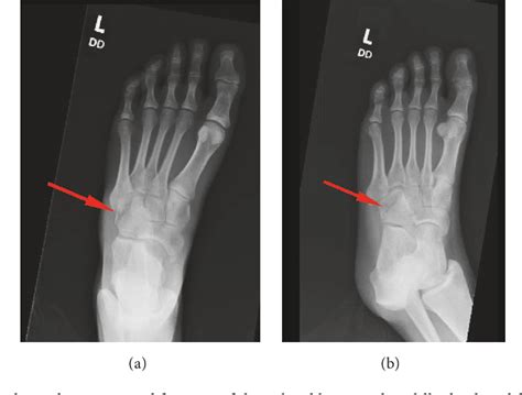 Figure 1 From Nutcracker Cuboid Fracture A Case Report And Review