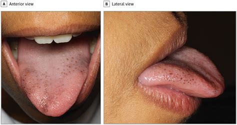 Pigmented Funorm Papillae Of The Tongue Adolescent Medicine Jama