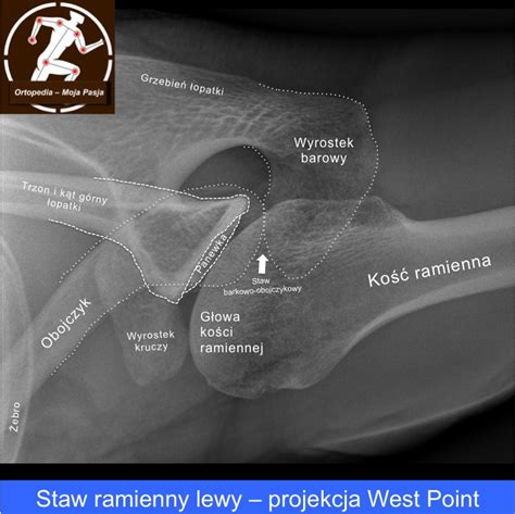 Zdj Cie Rtg Barku Projekcja West Point Micha Drwi Ga Lekarz Ortopeda