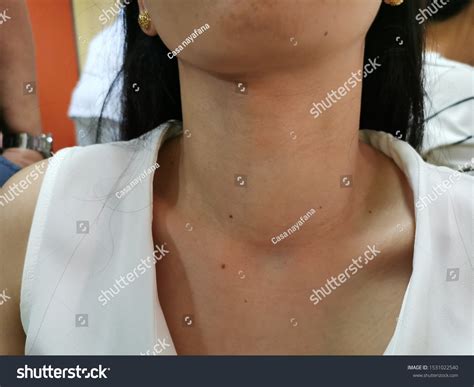 Diffuse Thyroid Swelling Goitre Cause Hypothyroidism Stock Photo
