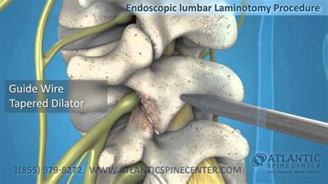 Endoscopic Spine Surgery Atlantic Spine Center