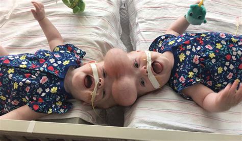 An Amazing Tale Of Bravery Conjoined Twins Reap Success With