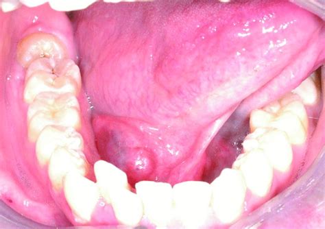 49 Salivary Gland Pathology Pocket Dentistry