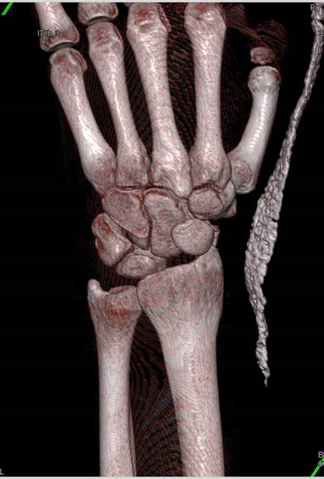 Scaphoid Fracture Trauma Case Studies Ctisus Ct Scanning