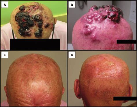 These tumors originate from sensory merkel cells. (A, B) Progressive Merkel cell carcinoma involving the ...