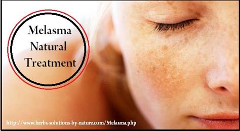 Melasma Natural Treatment That Have Been Proven To Work Herbs