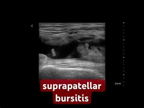 Suprapatellar Bursitis MSK Ultrasound YouTube