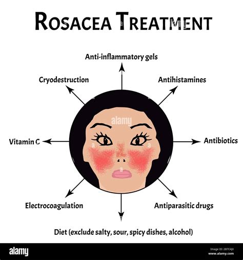 Rosacea Treatment Rosacea Awareness Month Infographics Vector