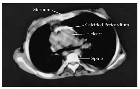 Diseases Of The Pericardium Cardiac Tumors And Cardiac