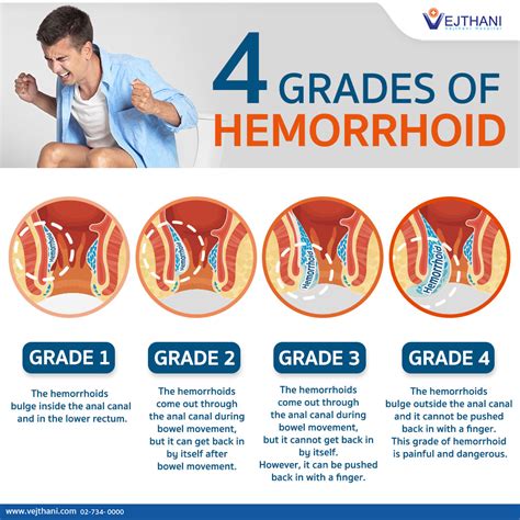 Internal Hemorrhoids Are Graded Into Different Categories According To The Severity Of The
