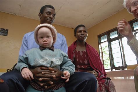 5 Albino Tanzanians Kids Get New Limbs New Life In Us