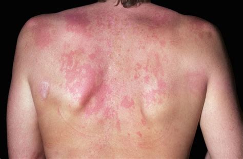 Second Antimalarial Agent May Be Effective In Cutaneous Lupus Despite